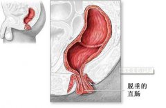 怎样预防直肠脱垂?