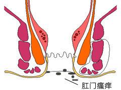 肛门瘙痒