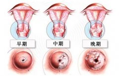 肛乳头瘤的症状会有哪些?