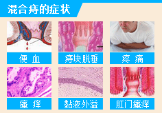 混合痔症状