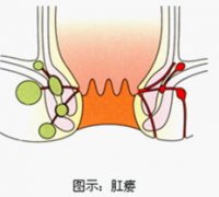 肛门部有脱出是否就是痔疮?