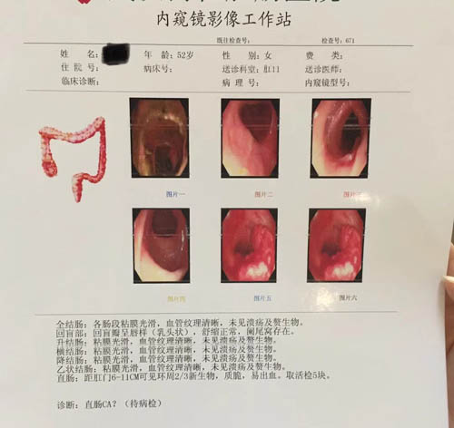 直肠肿瘤报告检查单