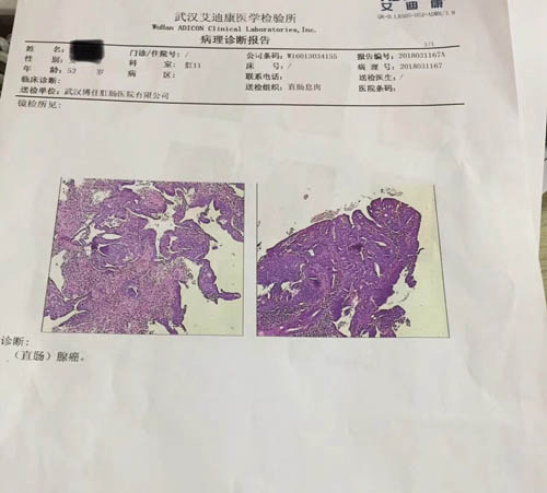 直肠肿瘤报告检查单