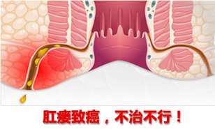 肛瘘致癌