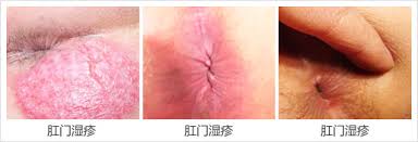 肛门湿疹