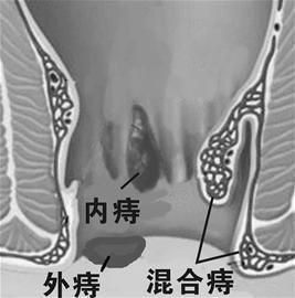 痔疮的分类
